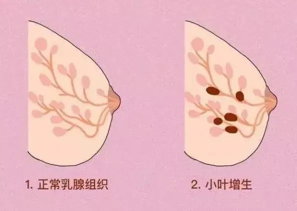 乳腺小叶增生经期后疼怎么回事_月经期前乳房胀痛查出小叶增生_小叶增生月经前乳房疼痛